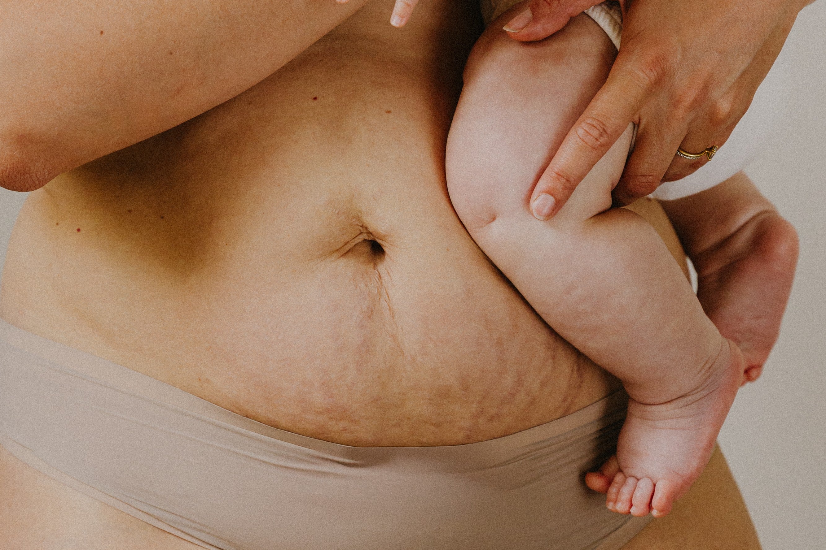 postpartum mom tummy stretch marks carrying newborn