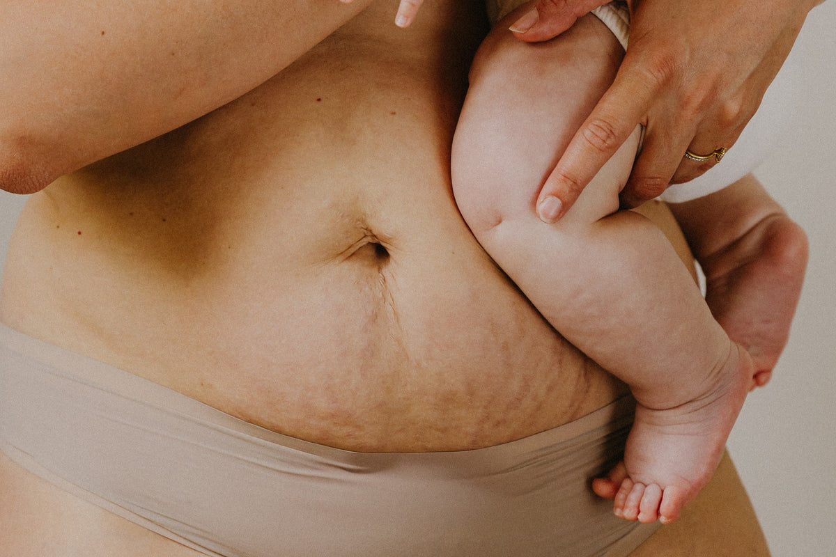 postpartum mom tummy stretch marks carrying newborn